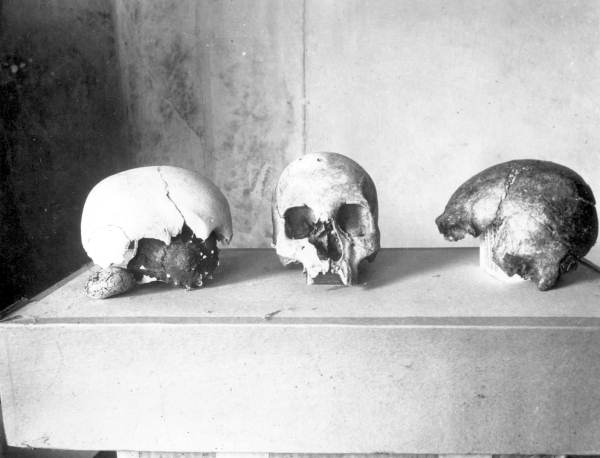 Human skulls from excavation - Miami Region, Florida