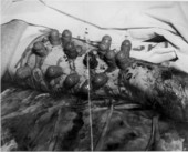 Close-up view of Gene Coppedge's leg with suction cups after diamondback rattlesnake bite - Boca Chica Key, Florida.